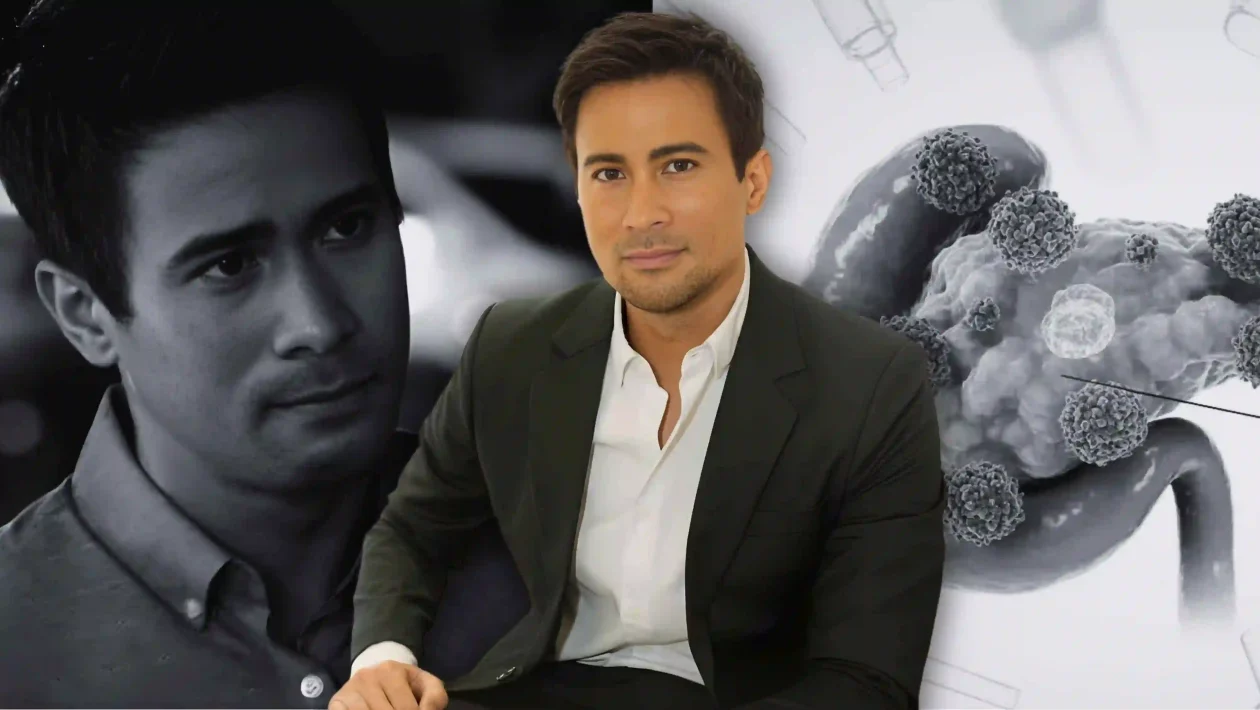 Sam Milby reveals he has latent autoimmune diabetes