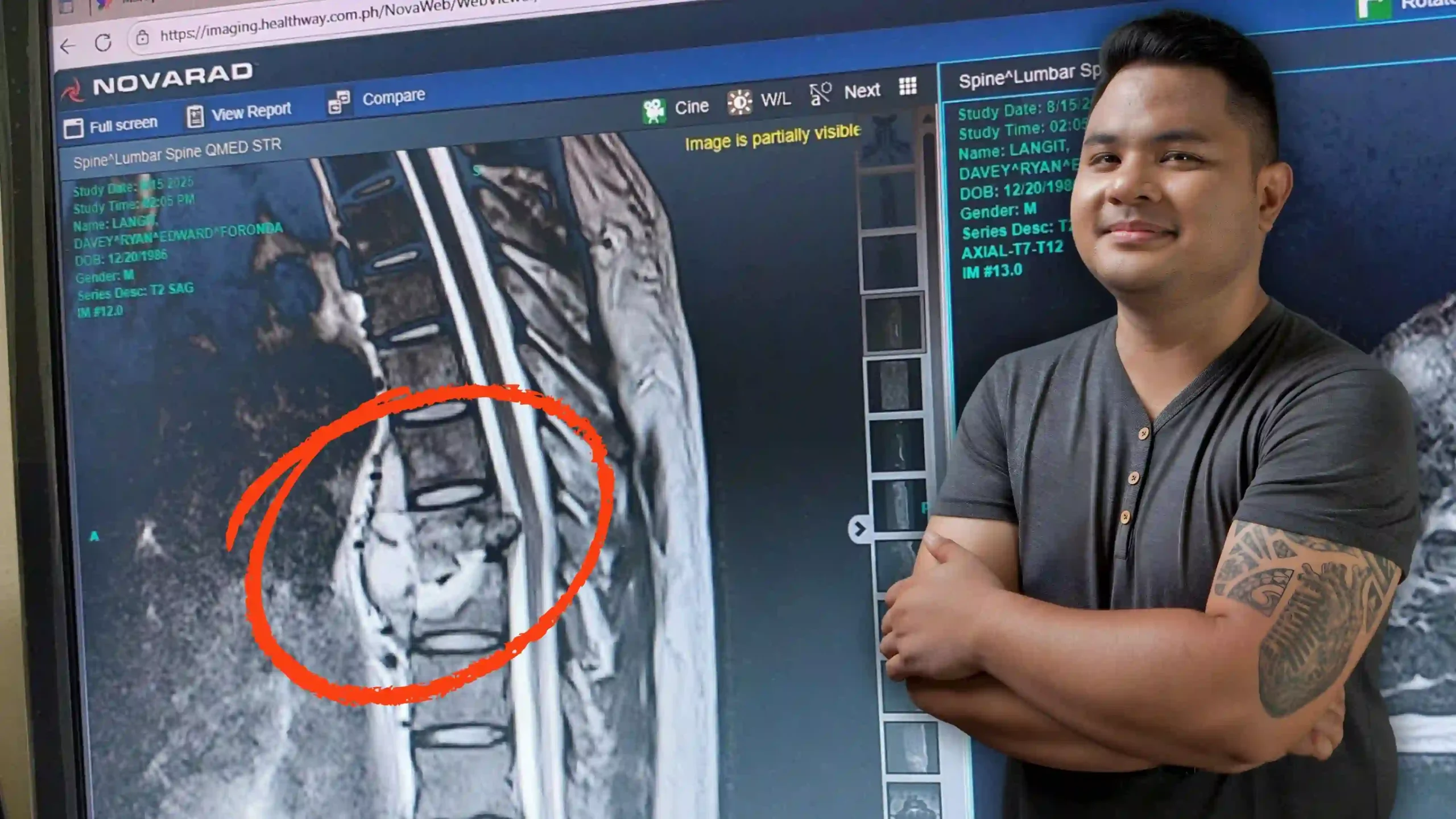Davey Langit was diagnosed with spondylodiscitis disease